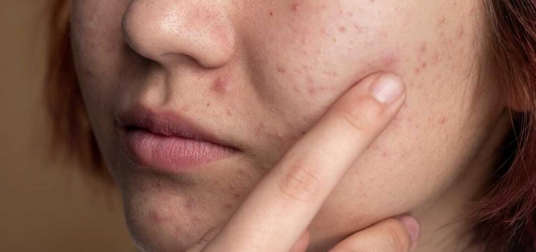 Troubleshooting acne edition